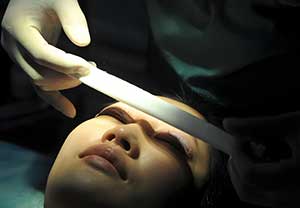 Double Eyelid Surgery