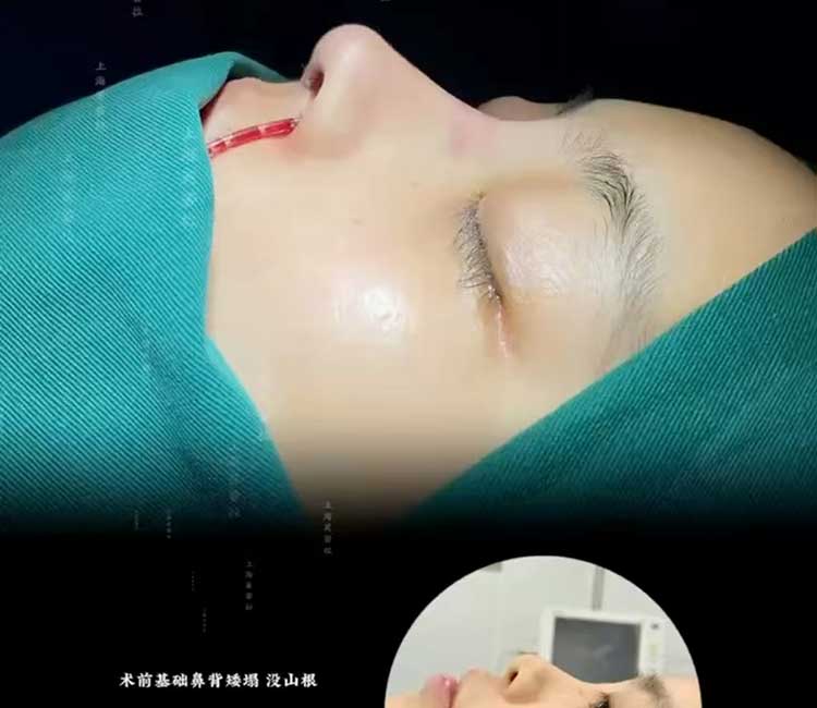 Rib Cartilage Rhinoplasty