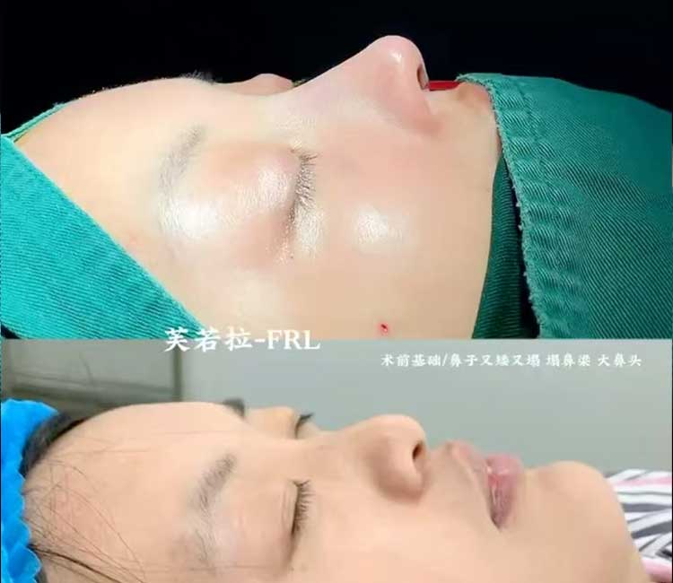 Autologous Rib Nose Sculpting