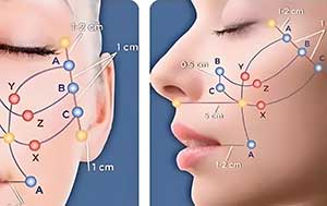 Magic Fascial Lift